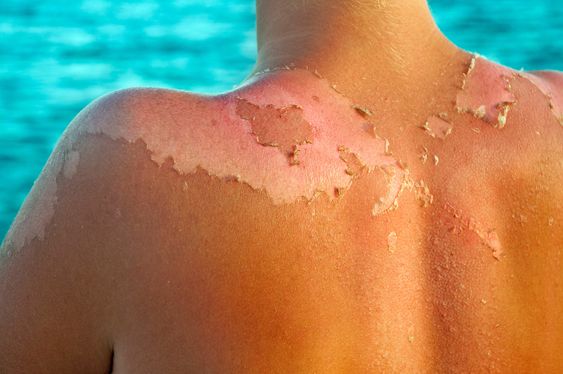 The Health Concerns of Modern Sunscreen and the Suncare Industry